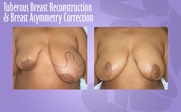 Tuberous Breast Reconstruction