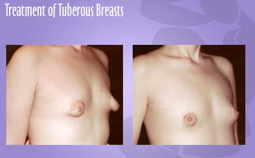 Tuberous Breasts
