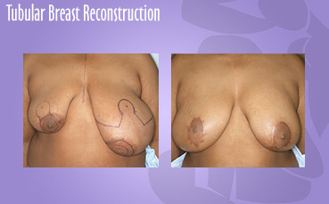Tubular breast reconstruction
