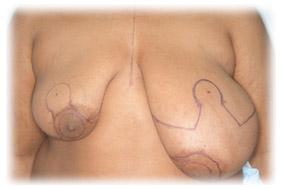 Breast Deformity