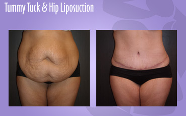 Abdominoplasty, Hip liposuction
