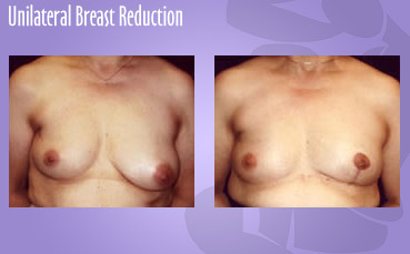Unilateral Breast Reduction