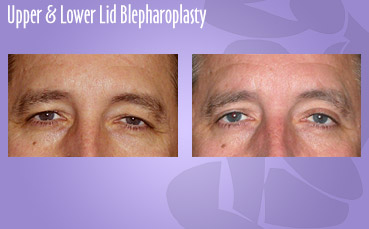 Upper and lower lid blepharoplasty