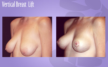 Vertical Breast Lift