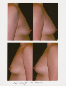 Before and after fat transfer from the abdomen and hips to the breasts. Note the increased fullness of the upper pole of the breast and the uplifting effect.