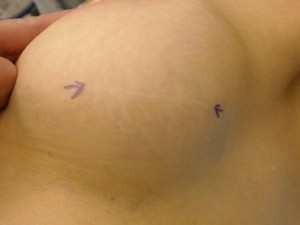 The scar is between the two purple arrows. 