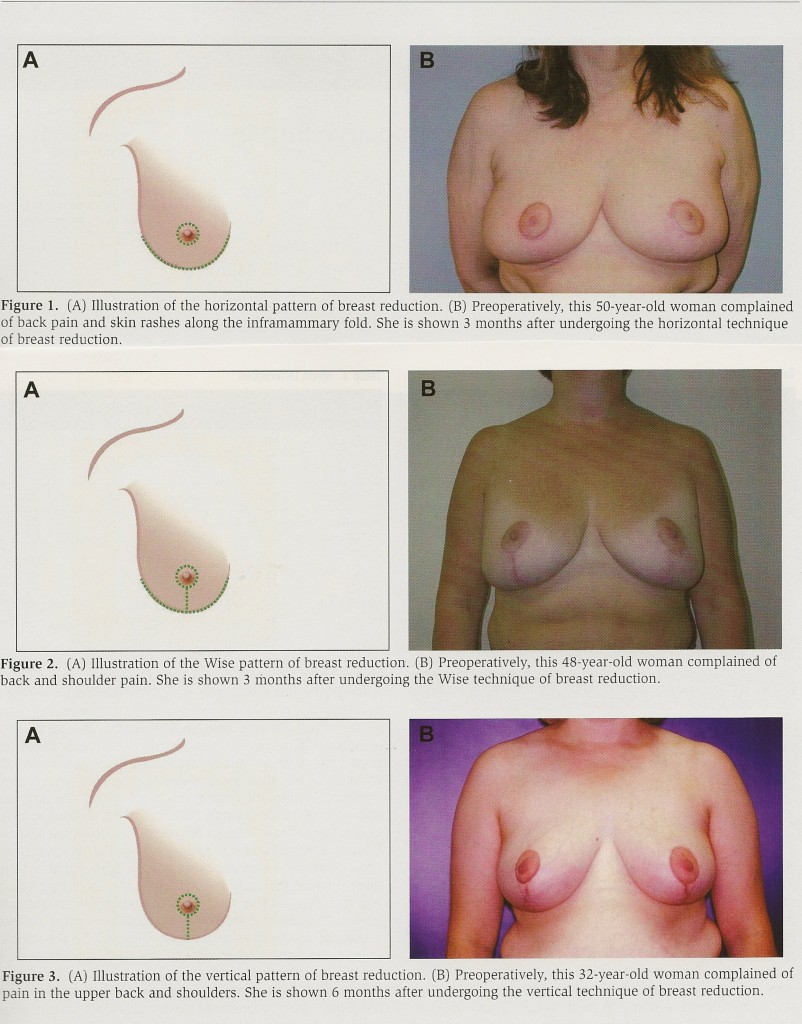 Illustrations and photos showing three breast reduction techniques.  