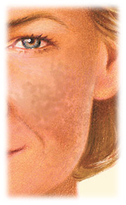 Facial Resurfacing with Croton oil chemical peel by Seattle Plastic Surgeon