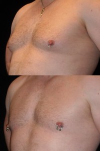 Top photo shows a guy embarrassed to take off his shirt.  Bottom photo shows a guy who feels and looks great after gynecomastia surgery and working out.