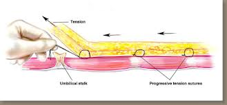 Progressive tension sutures secure the abdominal fat pad to the muscle.