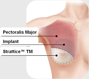 Seattle Plastic Surgeon loves acellular dermal matrix, Strattice.