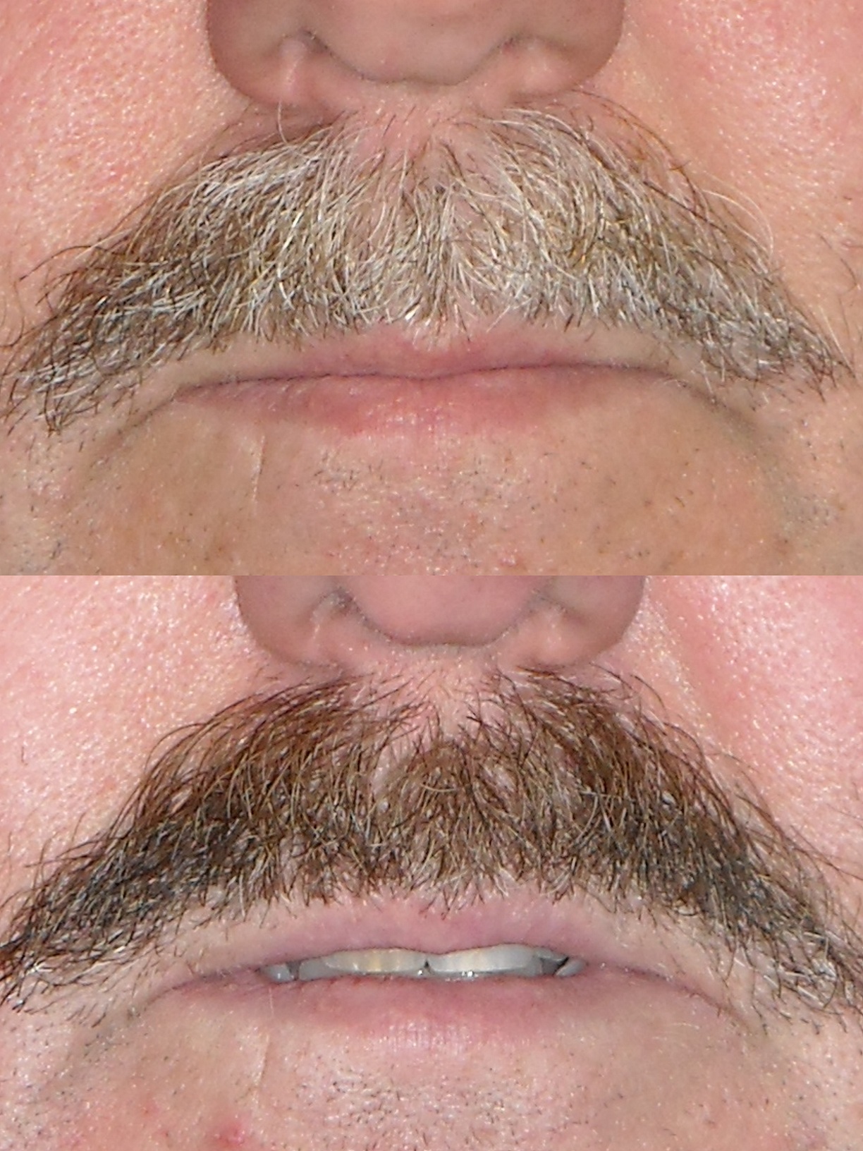 Mustache dye job seen by Seattle Plastic Surgeon